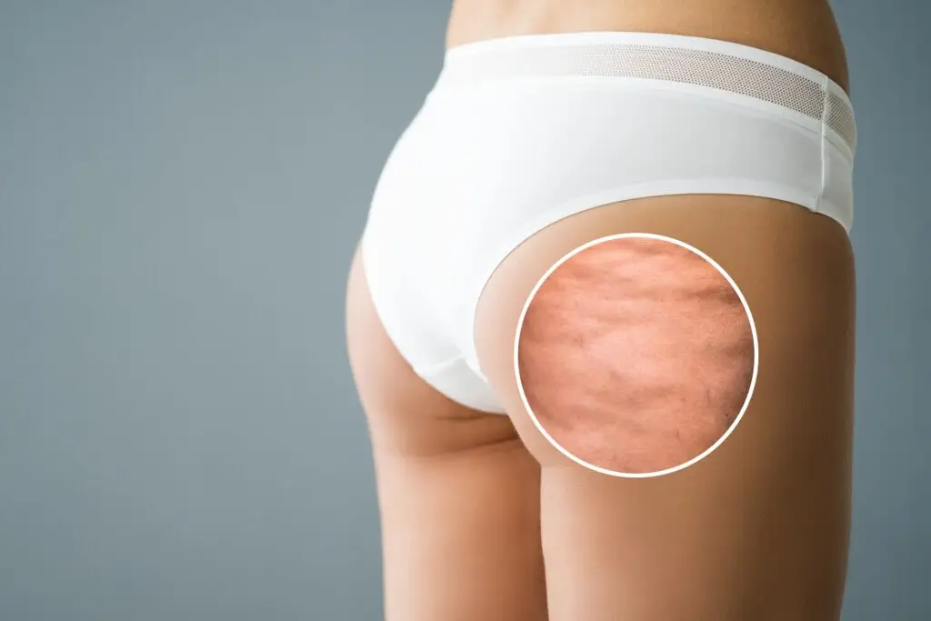 cellulite sur les fesses